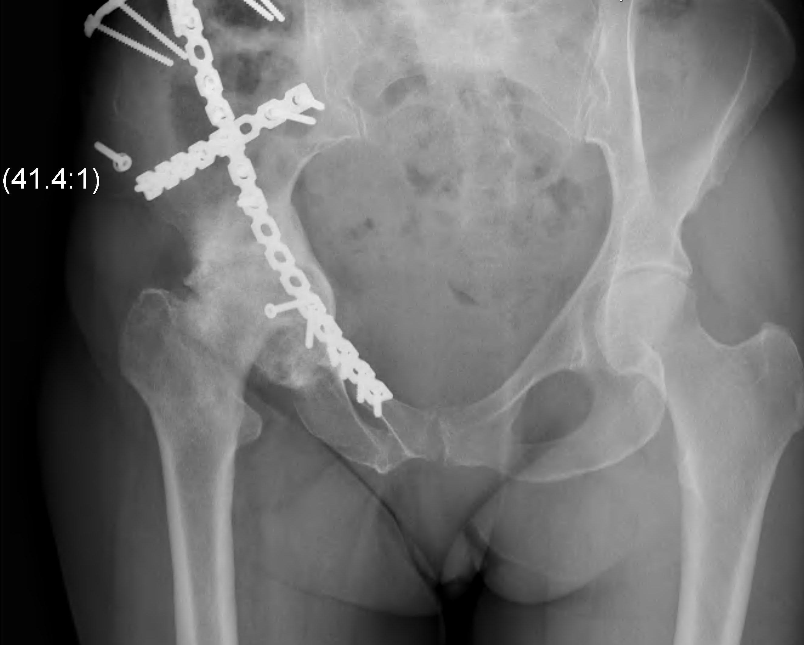 Hip OA post Acetabular Fracture
